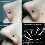 Nopull disco de silicona corrector de cicatrices hipertroficas para piercings