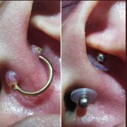 Nopull disco de silicona corrector de cicatrices hipertroficas para piercings